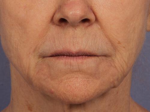 Injectable Fillers Gallery Before & After Image