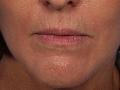 Injectable Fillers Gallery Before & After Image