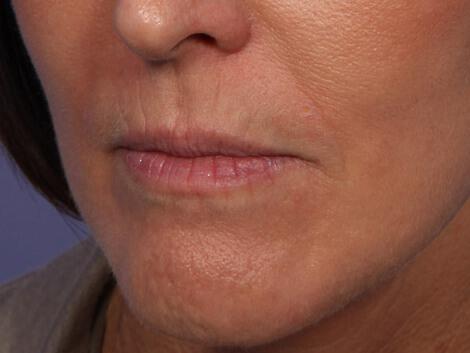 Injectable Fillers Gallery Before & After Image