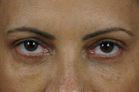 Injectable Fillers Gallery Before & After Image