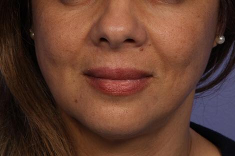 Injectable Fillers Gallery Before & After Image