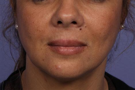 Injectable Fillers Gallery Before & After Image