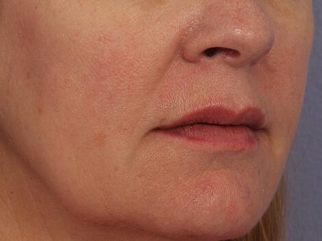 Injectable Fillers Gallery Before & After Image