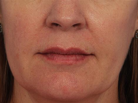 Injectable Fillers Gallery Before & After Image