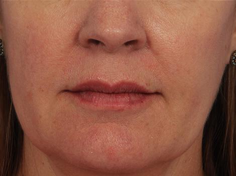 Injectable Fillers Gallery Before & After Image