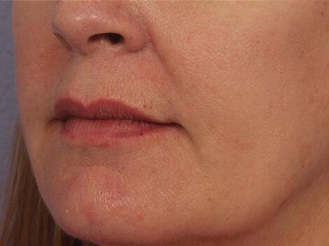 Injectable Fillers Gallery Before & After Image