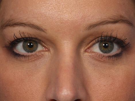 Injectable Fillers Gallery Before & After Image