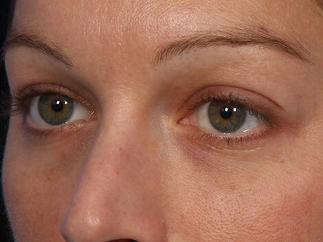 Injectable Fillers Gallery Before & After Image