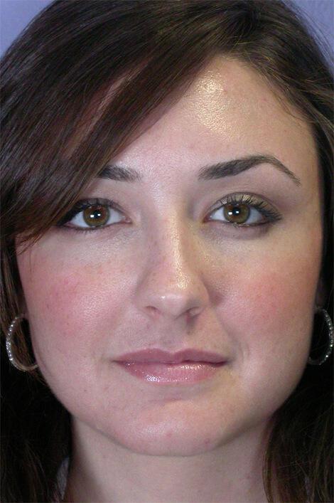 Injectable Fillers Gallery Before & After Image