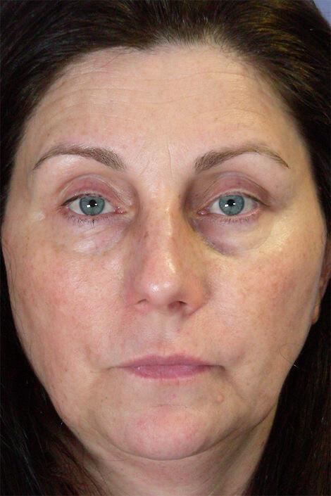 Injectable Fillers Gallery Before & After Image