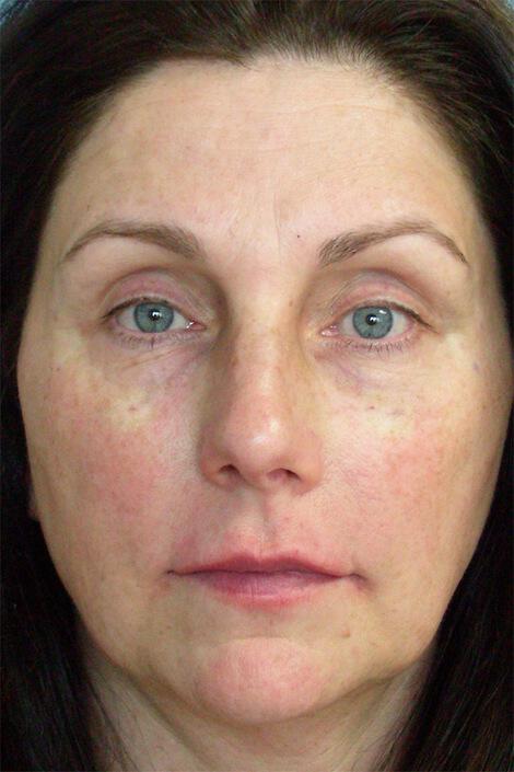 Injectable Fillers Gallery Before & After Image