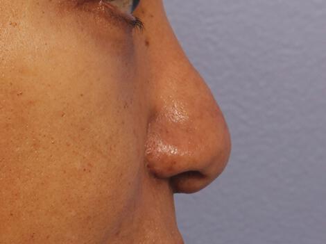 Injectable Fillers Gallery Before & After Image