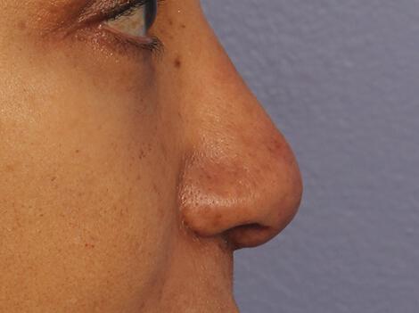 Injectable Fillers Gallery Before & After Image