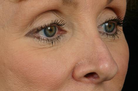 Injectable Fillers Gallery Before & After Image