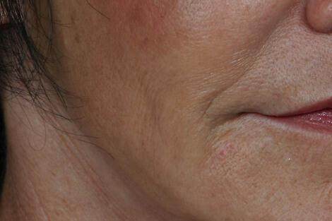 Injectable Fillers Gallery Before & After Image