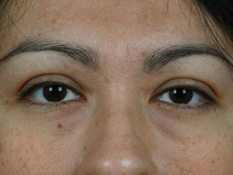 Injectable Fillers Gallery Before & After Image