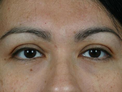 Injectable Fillers Gallery Before & After Image