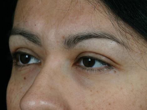 Injectable Fillers Gallery Before & After Image