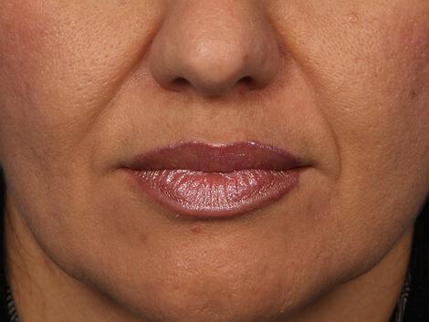 Injectable Fillers Gallery Before & After Image