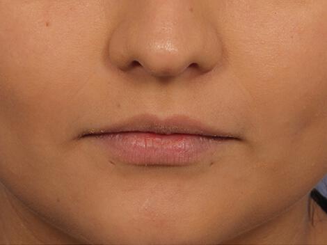 Injectable Fillers Gallery Before & After Image