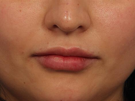 Injectable Fillers Gallery Before & After Image