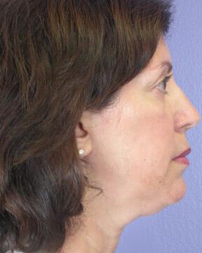 Injectable Fillers Gallery Before & After Image