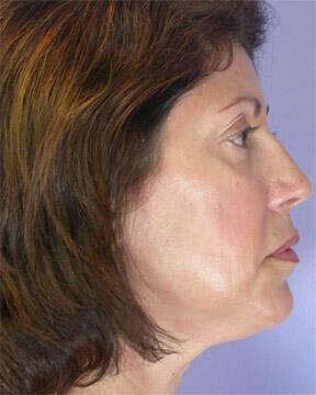 Injectable Fillers Gallery Before & After Image