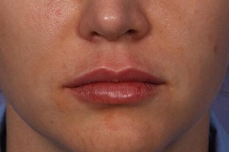 Injectable Fillers Gallery Before & After Image