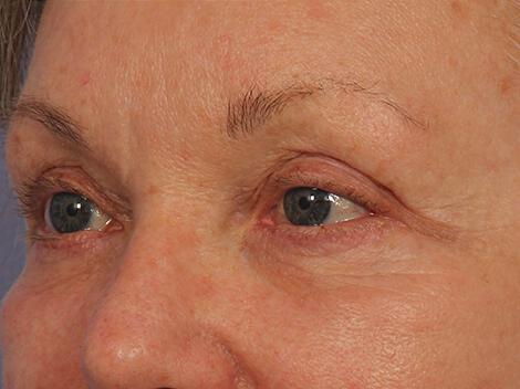 Injectable Fillers Gallery Before & After Image