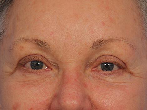 Injectable Fillers Gallery Before & After Image