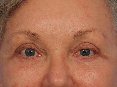 Injectable Fillers Gallery Before & After Image