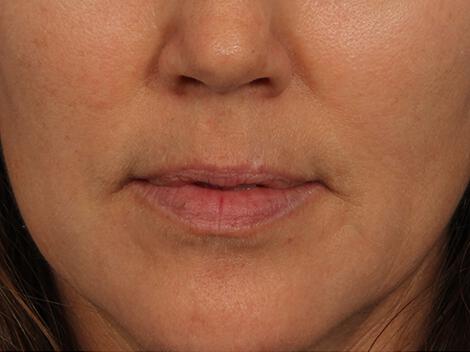 Injectable Fillers Gallery Before & After Image