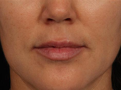 Injectable Fillers Gallery Before & After Image