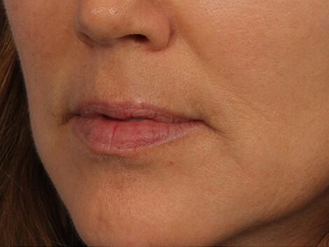 Injectable Fillers Gallery Before & After Image