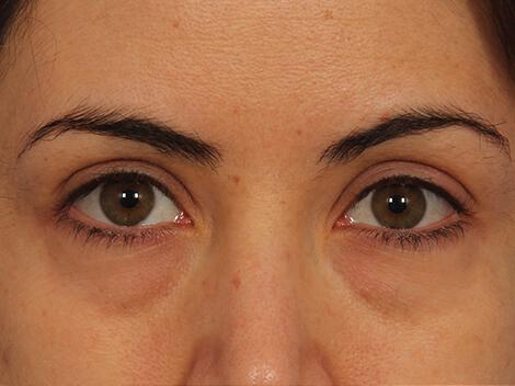 Injectable Fillers Gallery Before & After Image