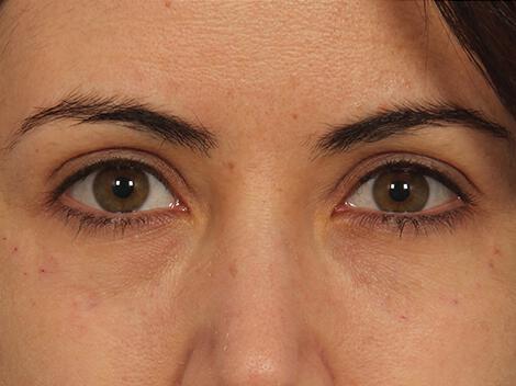 Injectable Fillers Gallery Before & After Image