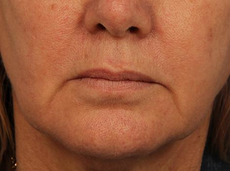 Injectable Fillers Gallery Before & After Image