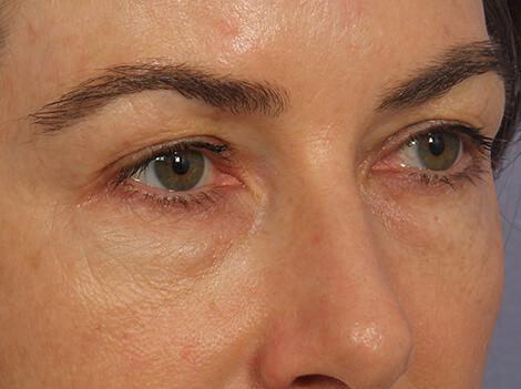 Injectable Fillers Gallery Before & After Image