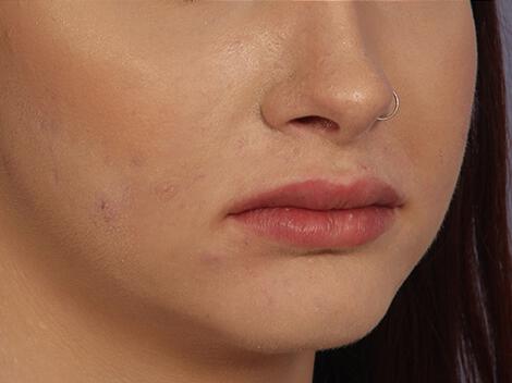 Injectable Fillers Gallery Before & After Image