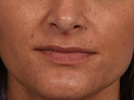 Injectable Fillers Gallery Before & After Image