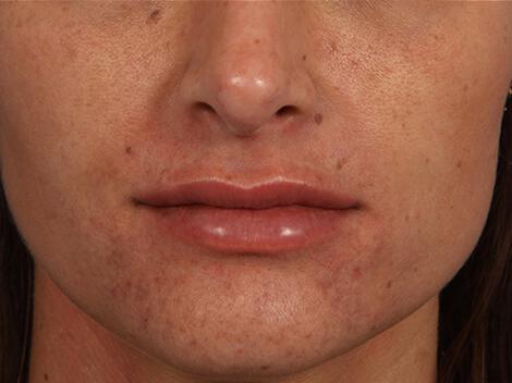 Injectable Fillers Gallery Before & After Image