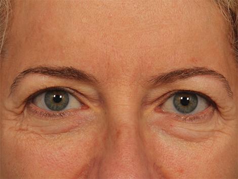 Injectable Fillers Gallery Before & After Image