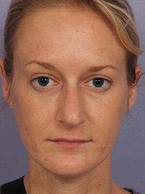 Injectable Fillers Gallery Before & After Image