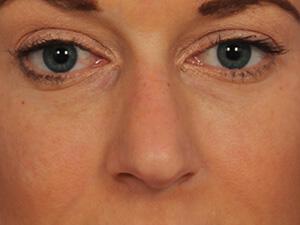 Injectable Fillers Gallery Before & After Image