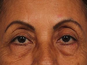 Injectable Fillers Gallery Before & After Image