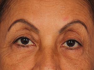 Injectable Fillers Gallery Before & After Image