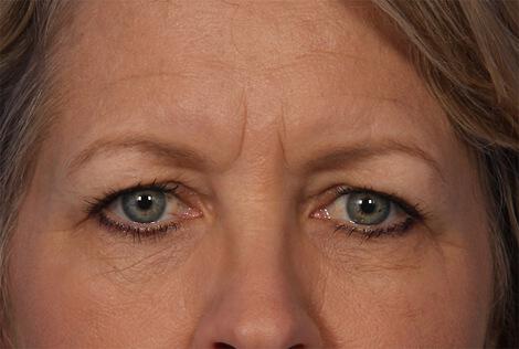 Injectable Fillers Gallery Before & After Image