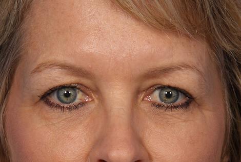 Injectable Fillers Gallery Before & After Image