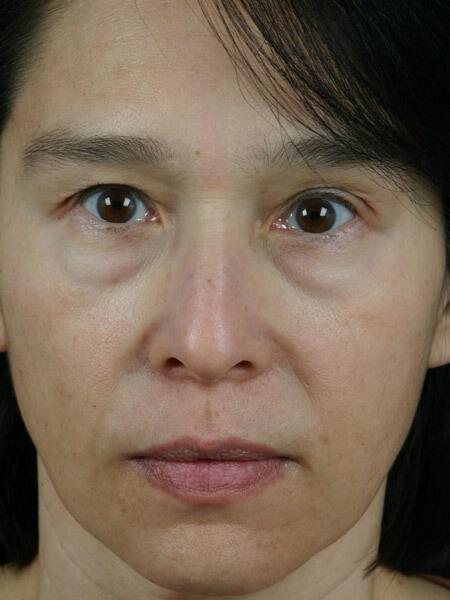 Injectable Fillers Gallery Before & After Image