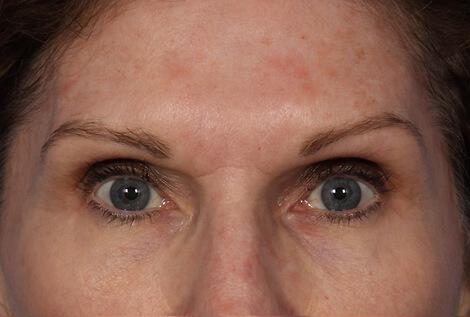 Injectable Fillers Gallery Before & After Image